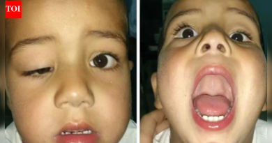 मार्कस गन सिंड्रोम म्हणजे काय, ज्यामध्ये पापणी जबड्याने हलते: धोके आणि वारसा समजून घेणे