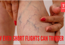 एका तासाच्या उड्डाणानंतर महिला डीप वेन थ्रोम्बोसिससह रुग्णालयात दाखल; हे का घडते हे शीर्ष डॉक्टर प्रकट करतात